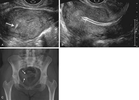 Ultrasound Evaluation of the Fallopian Tube | Obgyn Key