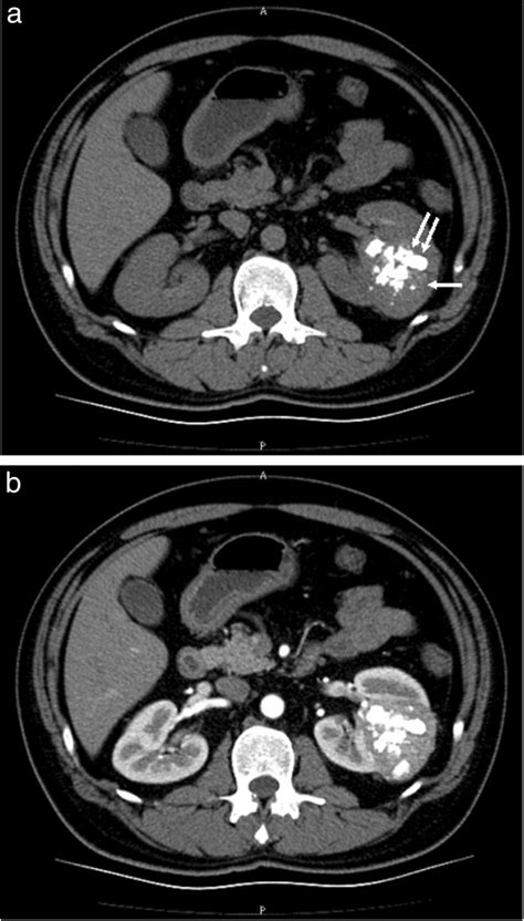 CT scan of the angiomyolipoma (AML) of the left kidney. (a) Noncontrast... | Download Scientific ...