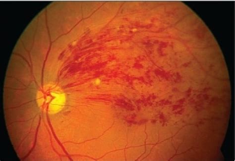 Understanding Branch Retinal Vein Occlusion - Malik Eye Care