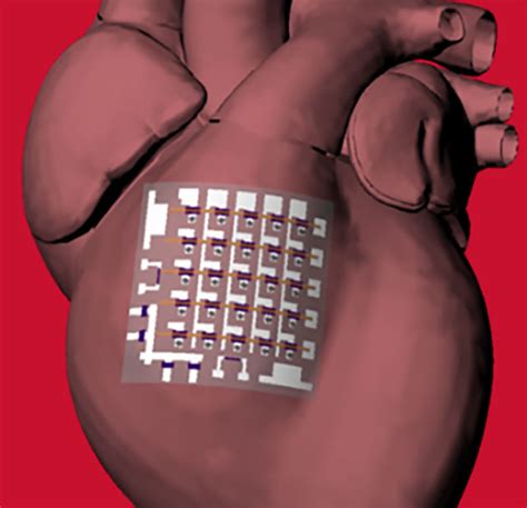 Implantable Device Can Monitor and Treat Heart Disease - Tech Briefs