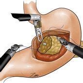 Extended Kocher maneuver with exposure of the left renal vein, aorta,... | Download Scientific ...