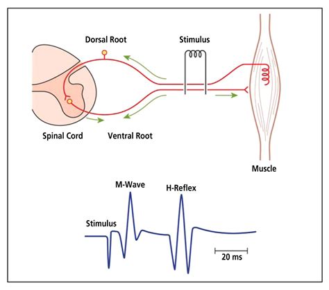 Effect of Counterstrain on Stretch Reflexes, Hoffmann Reflexes, and Clinical Outcomes in ...