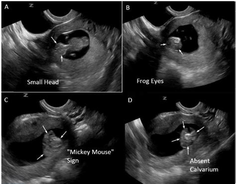 Check the Head: Emergency Ultrasound Diagnosis of Fetal Anencephaly - The Western Journal of ...