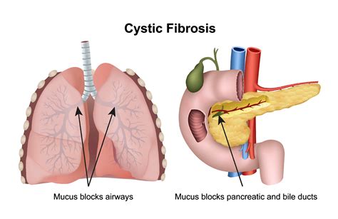 Pediatric Cystic Fibrosis | OHSU