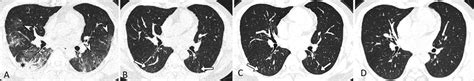 Serial transverse CT scans in a 39-year-old man with moderate COVID-19.... | Download Scientific ...