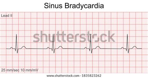 306 Sinus Bradycardia Images, Stock Photos, 3D objects, & Vectors ...