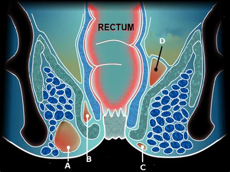 Perirectal Abscess | Treatment & Management | Point of Care