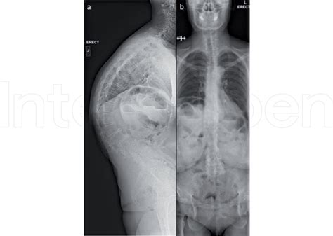 [PDF] The Functional Effects of Adult Spinal Deformity and the Effectiveness of Surgery ...