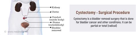 Cystectomy - Indications, Types, Procedures, Risks and Complications