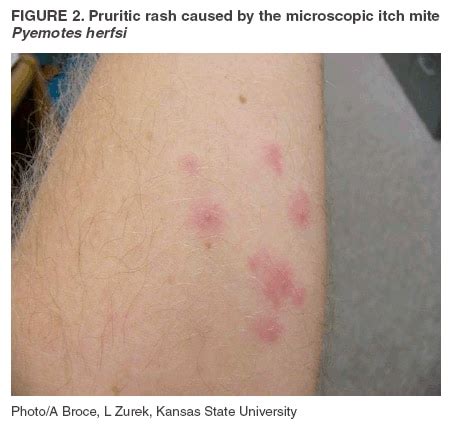 Outbreak of Pruritic Rashes Associated with Mites --- Kansas, 2004