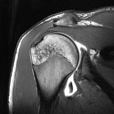 Radiology Cases: Hill Sachs and Bankart Lesions