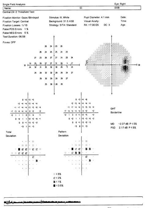 Glaucoma Eye Test