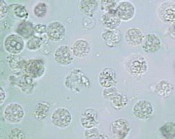 Leukocytes In Urine Means / Kidney Stones Cause Elevated White Blood Cell Count / The presence ...