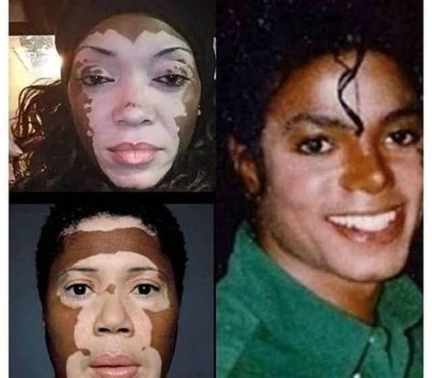 Skin Bleaching Michael Jackson