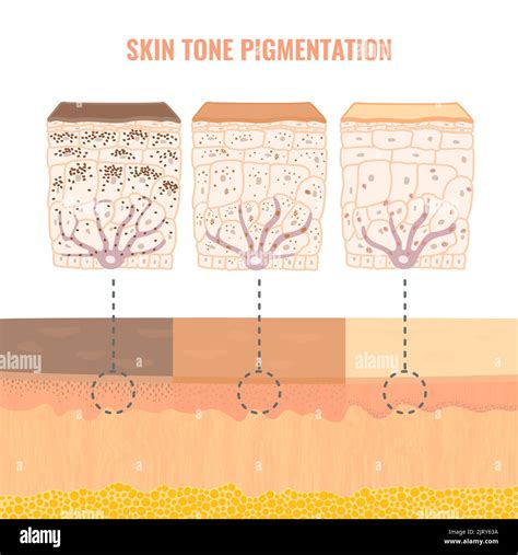 Skin pigmentation, illustration Stock Photo - Alamy