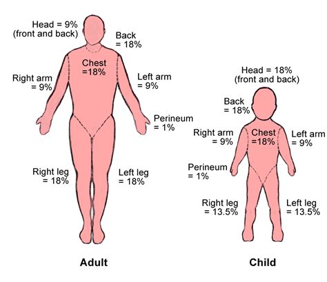 Medical Lecture Notes Online: BURN ASSESSMENT AND MANAGEMENT