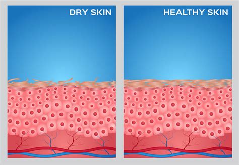 What is dry skin? – Asia Healthcare Sdn Bhd