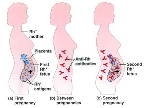 Rhesus disease or Rh disease causes, prevention, symptoms, treatment & prognosis