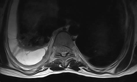 Tuberculous myelitis with intraspinal abscess | Image | Radiopaedia.org