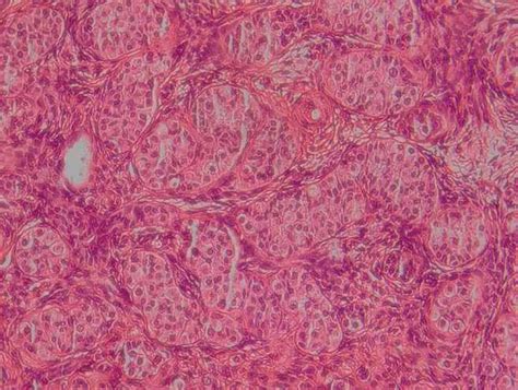 Early development of a gonadal tumor in a patient with mixed gonadal dysgenesis - Archives of ...