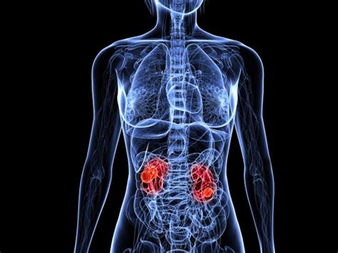 Understanding the Spread: Metastatic Renal Cell Carcinoma