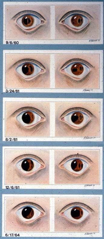 Axenfeld-Rieger Syndrome, Type 1 | Hereditary Ocular Diseases