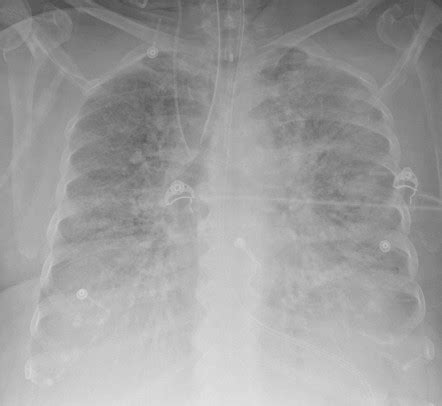 Ards Chest X Ray - lusomentepalavras