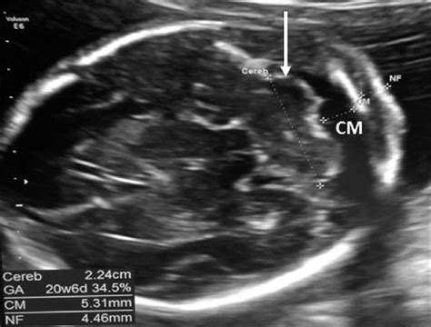 Cisterna Magna Ultrasound