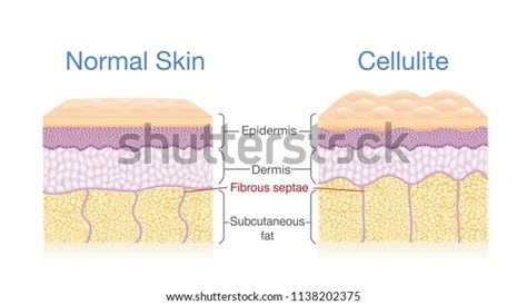 Fat Layer: Over 2,457 Royalty-Free Licensable Stock Vectors & Vector Art | Shutterstock