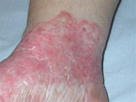 Tinea incognito, causes, symptoms, diagnosis & treatment