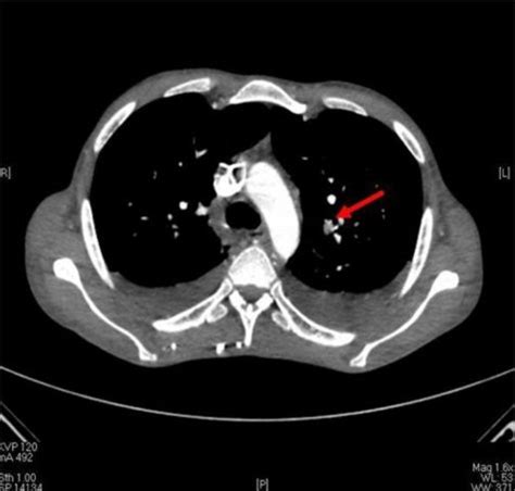 CT scan of the chest showing pulmonary embolism (arrow). | Download Scientific Diagram