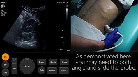 Ultrasound Tutorial: Kidney & Bladder / Urinary Tract | Radiology Nation - YouTube