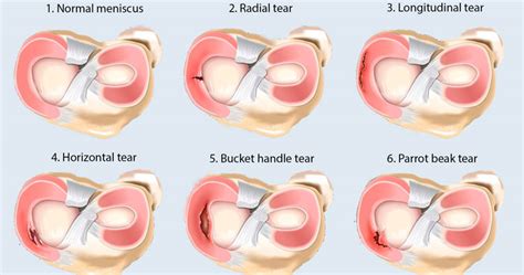 Types Of Meniscus Tear | Sydney Physio Clinic | Macquarie Street