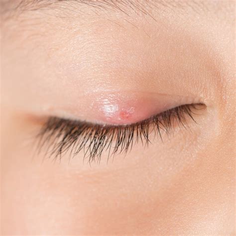 Stye in my Eye - What is it? | Alpine Eye Care