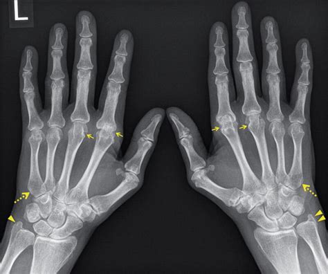 Osteoarthritis Hands X Ray