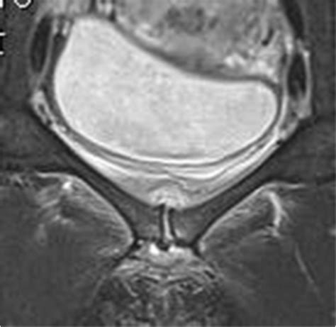 MRI showing oedema of the symphysis protruding both cranio-dorsally,... | Download High ...