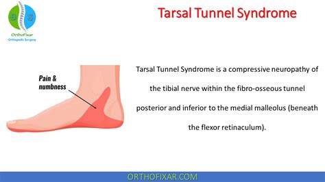 Top more 10 tarsal tunnel syndrome exercises Latest - Bút Chì Xanh