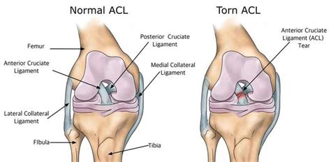 ACL Tear surgery in Jaipur by Dr. Lalit Modi at JaipurJoints.