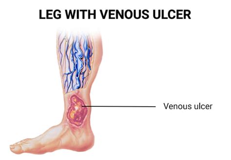 Venous Stasis Ulcer - Vein & Endovascular Medical Care