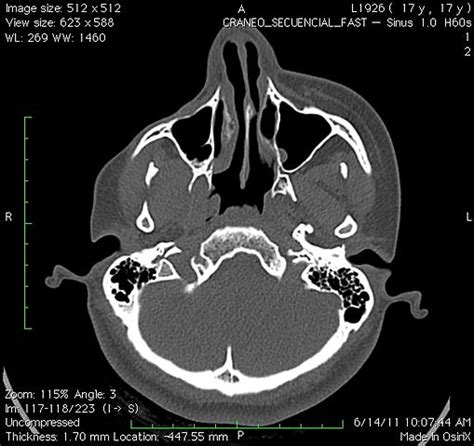 Parry Romberg Syndrome | Signs and Symptoms, Causes & Treatment