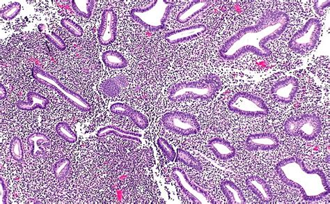 Disordered proliferative endometrium - MyPathologyReport.ca