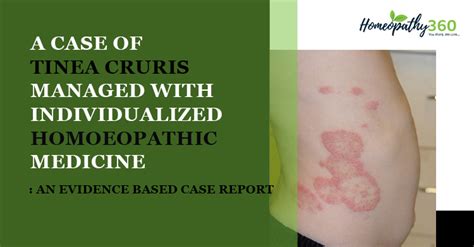 A Case of Tinea Cruris Managed with Individualized Homoeopathic ...