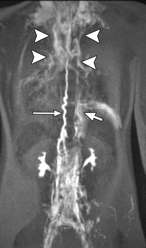 MR Lymphangiography in Children: Technique and Potential Applications | RadioGraphics