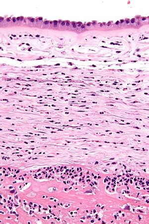 Chorioamnionitis - Libre Pathology