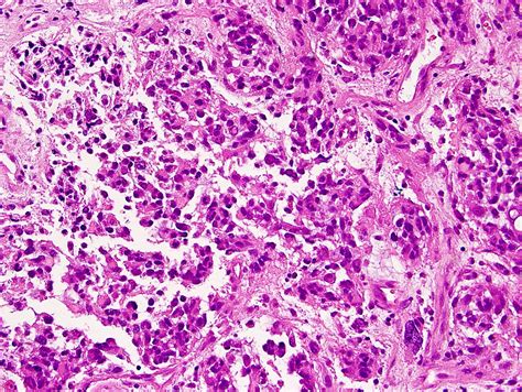 Pathology Outlines - Gliosarcoma