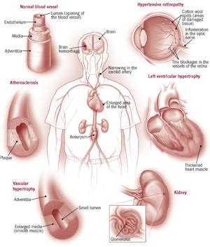 6 Serious Effects of High Blood Pressure | Blue Heron Natural Health News