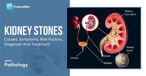 Kidney Stones: Causes, Symptoms, Risk Factors, Diagnosis and Treatment