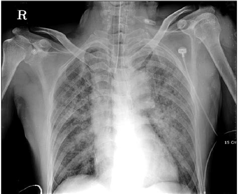 The chest X-ray finding of case 2. Diffuse alveolar pattern of... | Download Scientific Diagram