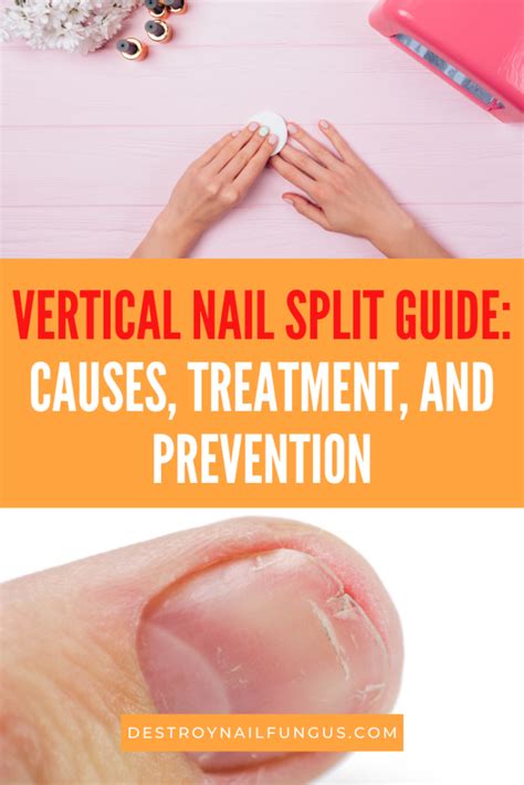 How To Fix A Vertical Nail Split: A Comprehensive Guide