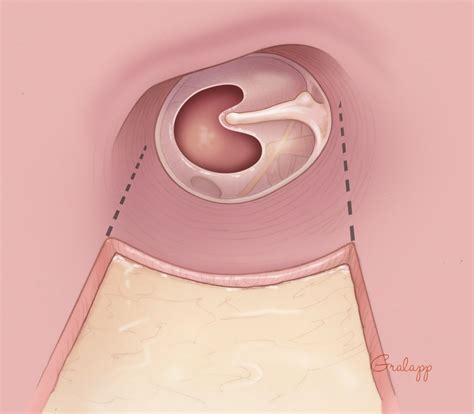 Tympanoplasty – Oto Surgery Atlas